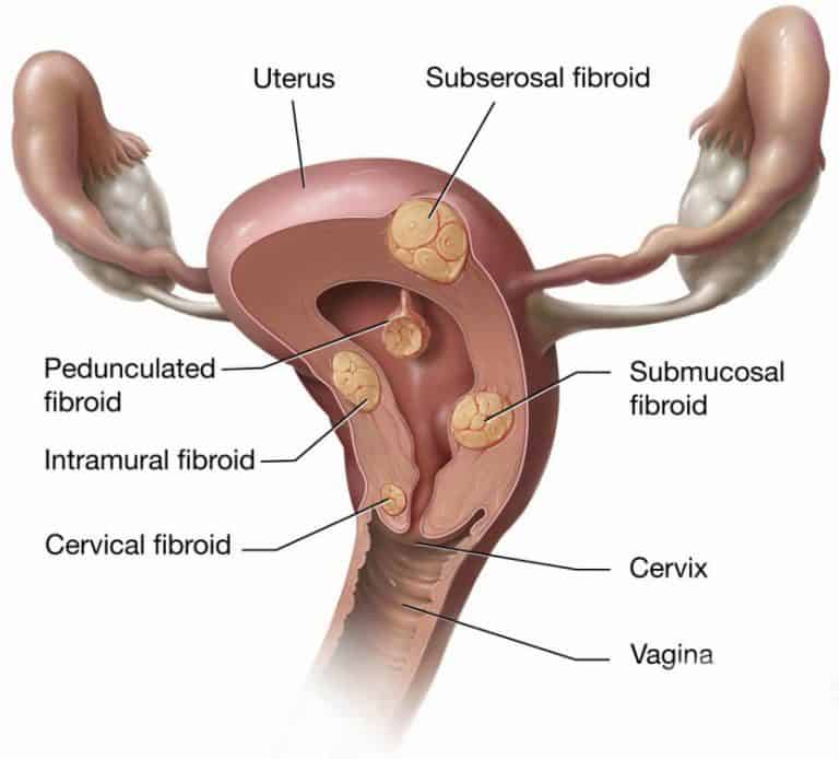 Types of fibroids in the uterus by NIH Medical Arts